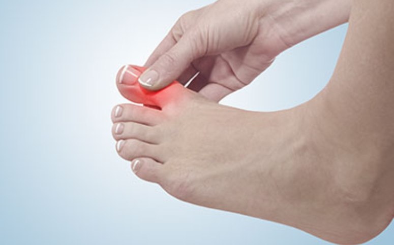 युरिक एसिड