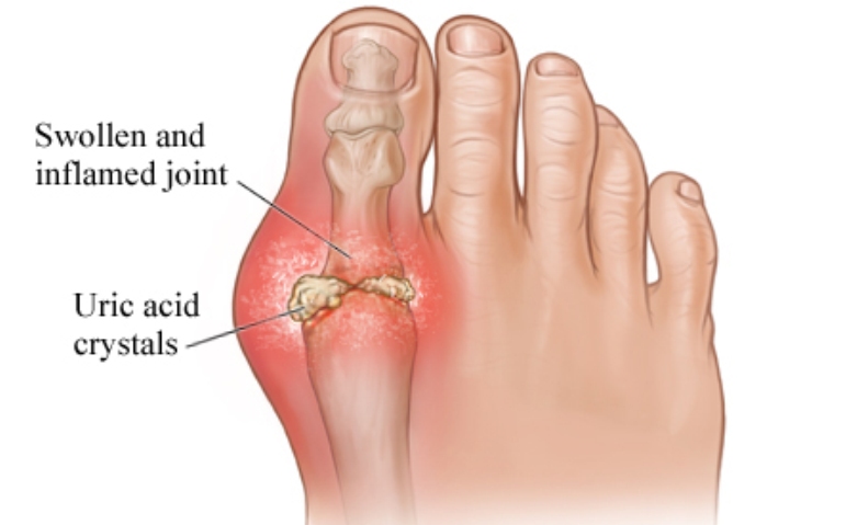 युरिक एसिड
