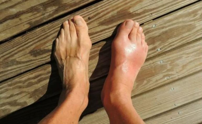 गठिया वाथ