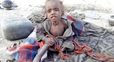 कुपोषणको समस्या