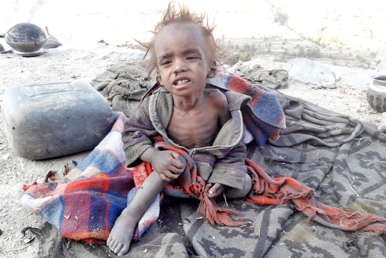 कुपोषणको समस्या