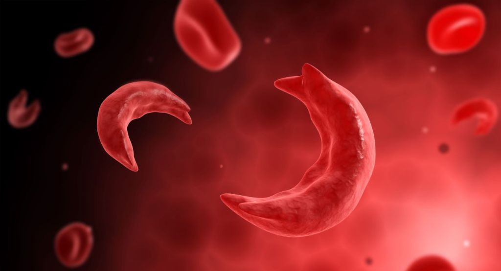सिकलसेल एनिमिया
