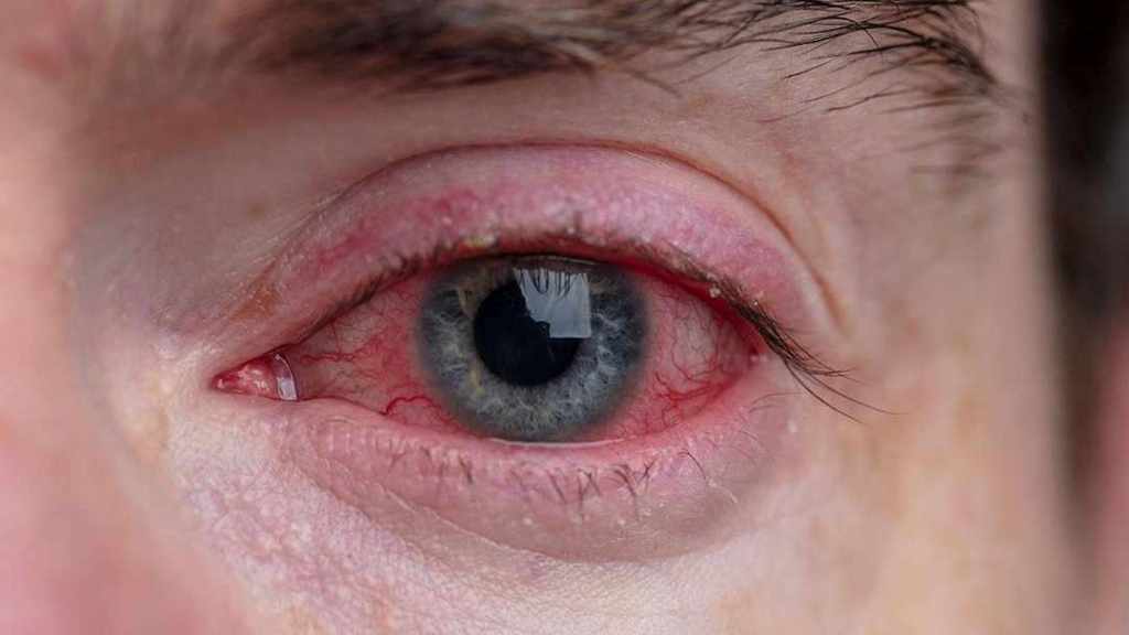 कन्जक्टिवाइटिस